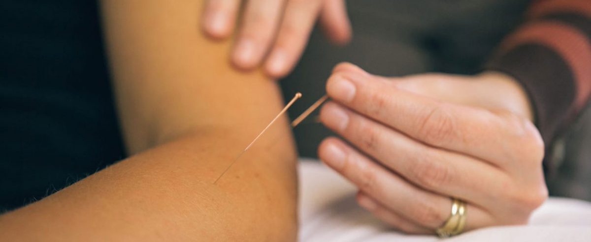 Acupuncture Therapy | Panorama Physiotherapy & Sports Clinic