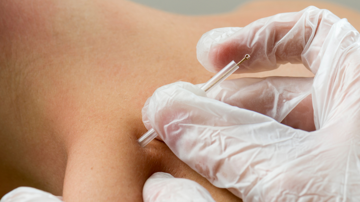 benefits of dry needling